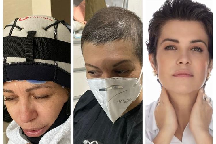 Médica conta que a perda do cabelo durante o tratamento de câncer de mama mudou sua percepção da própria beleza