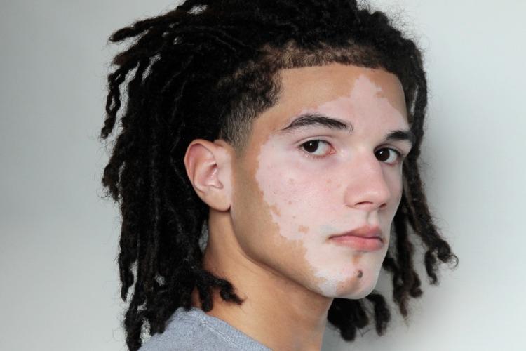 Jovem com vitiligo quebra barreiras e desponta como modelo