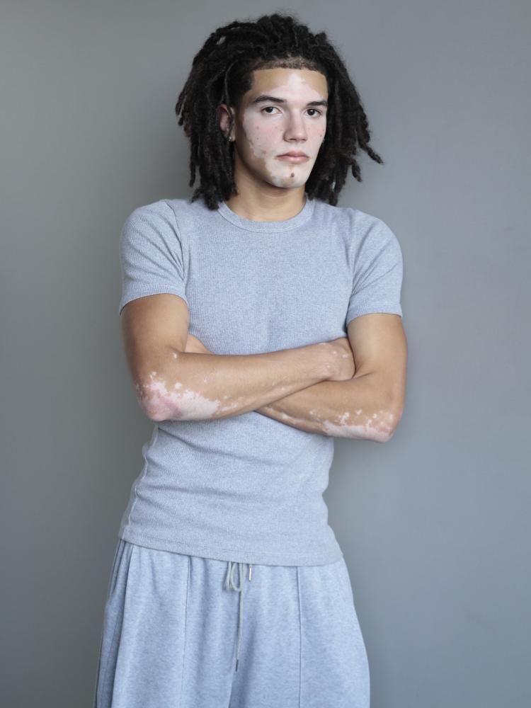 Sugestão: jovem com vitiligo quebra barreiras e desponta como modelo