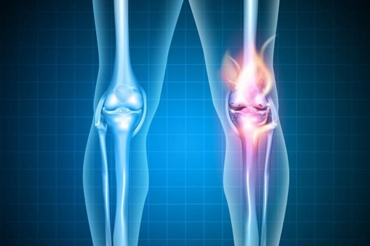 Artrose de joelho: prescrição de exercícios físicos com os melhores resultados serão debatidas em Fórum Internacional em São Paulo