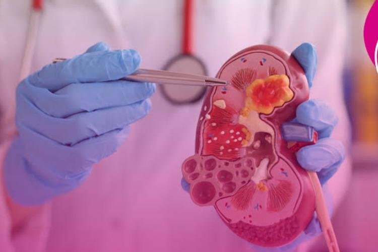 Nefrite lúpica: diagnóstico e tratamento são desafios para preservar a função renal
